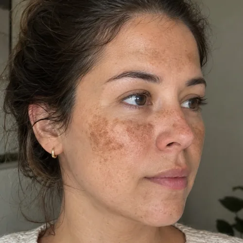 Melasma